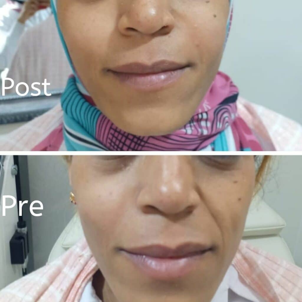 حقن الفيلر في الغردقة لازالة خطوط الابتسامة